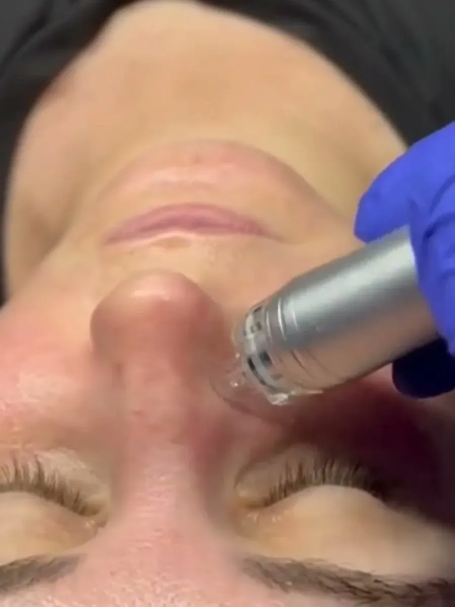 Hydrodermabrasion