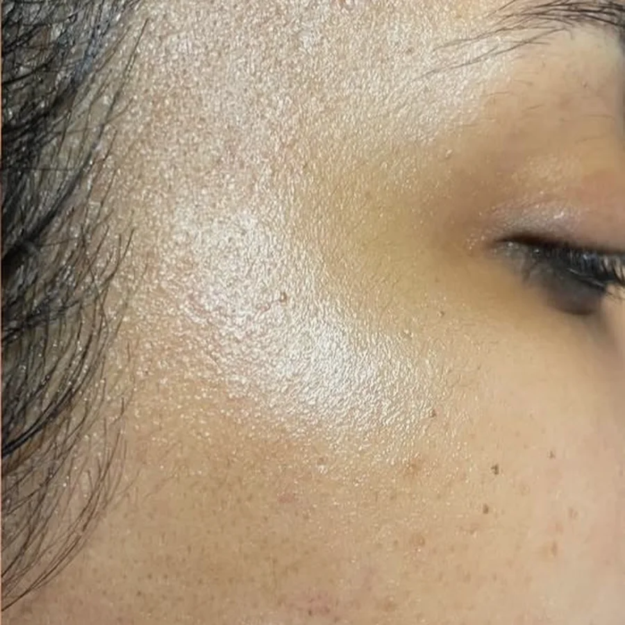 After dermaplaning