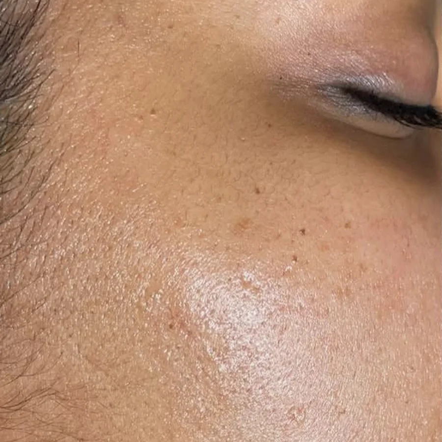 Before dermaplaning