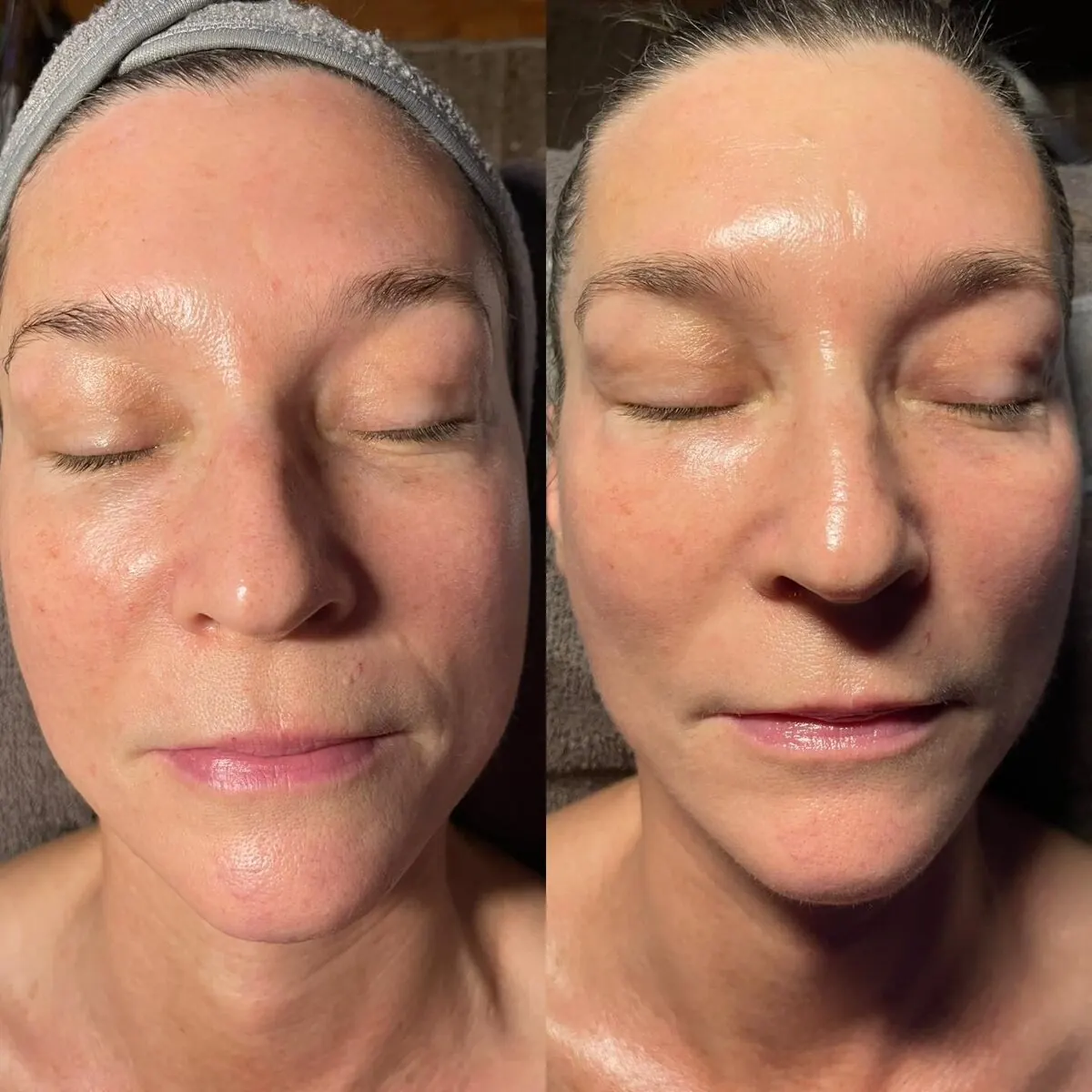 Hydrodermabrasion before and after
