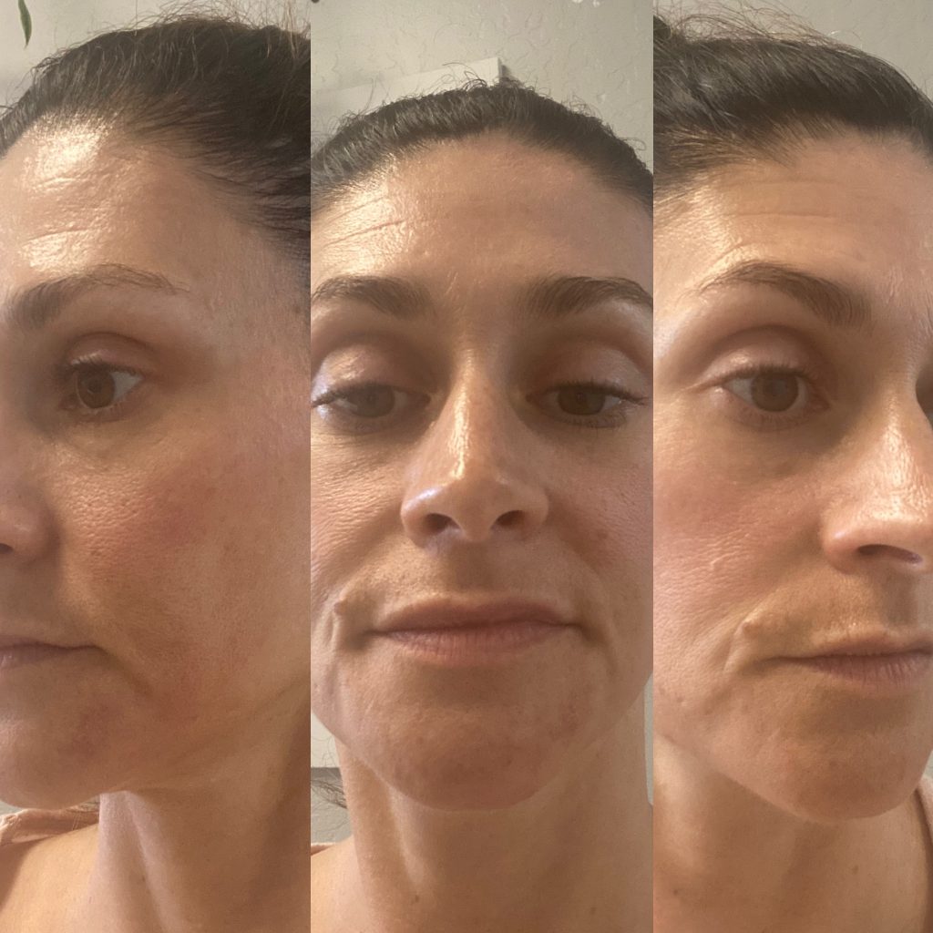 chemical peel on white female in her late 30's